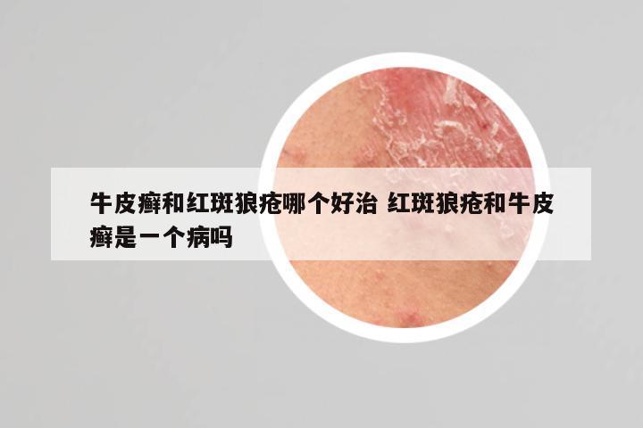 牛皮癣和红斑狼疮哪个好治 红斑狼疮和牛皮癣是一个病吗