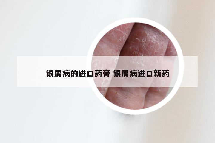 银屑病的进口药膏 银屑病进口新药