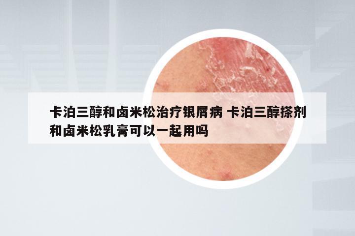 卡泊三醇和卤米松治疗银屑病 卡泊三醇搽剂和卤米松乳膏可以一起用吗