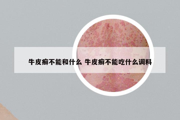 牛皮癣不能和什么 牛皮癣不能吃什么调料