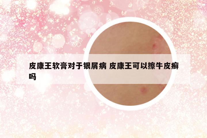 皮康王软膏对于银屑病 皮康王可以擦牛皮癣吗