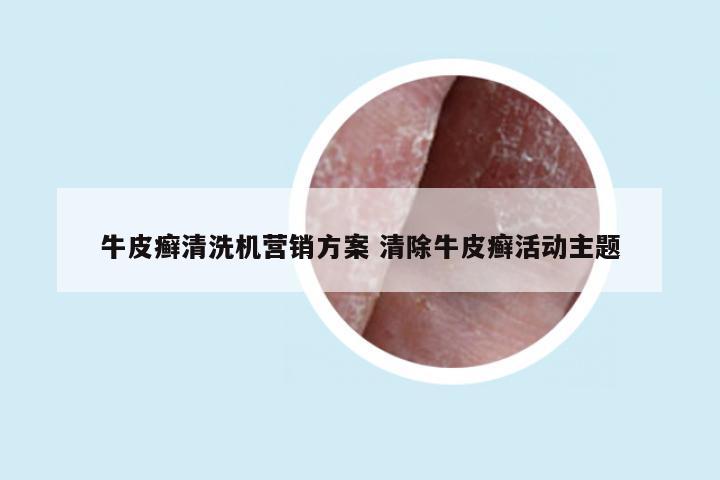牛皮癣清洗机营销方案 清除牛皮癣活动主题