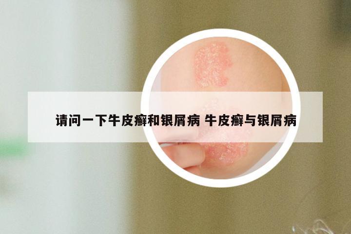 请问一下牛皮癣和银屑病 牛皮癣与银屑病
