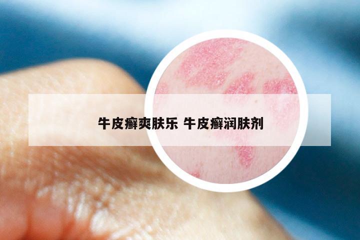 牛皮癣爽肤乐 牛皮癣润肤剂