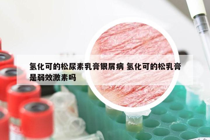 氢化可的松尿素乳膏银屑病 氢化可的松乳膏是弱效激素吗