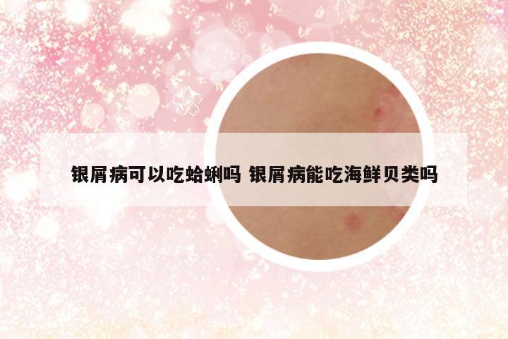 银屑病可以吃蛤蜊吗 银屑病能吃海鲜贝类吗