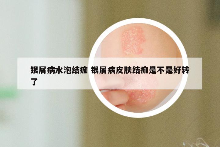 银屑病水泡结痂 银屑病皮肤结痂是不是好转了
