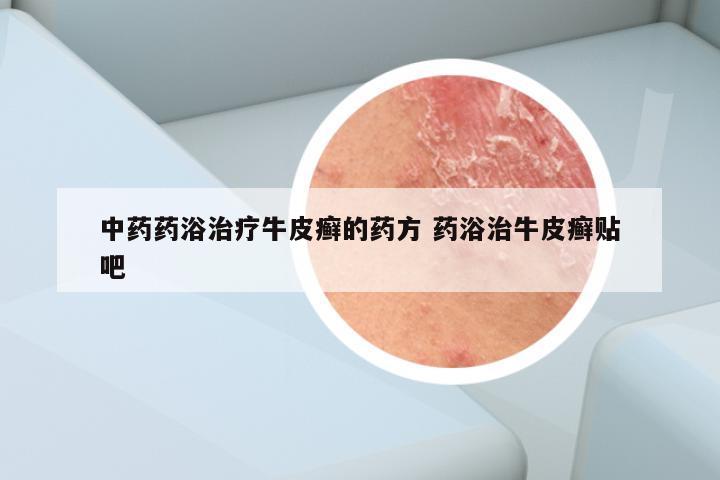 中药药浴治疗牛皮癣的药方 药浴治牛皮癣贴吧