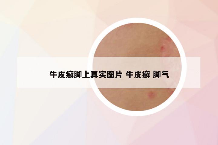 牛皮癣脚上真实图片 牛皮癣 脚气