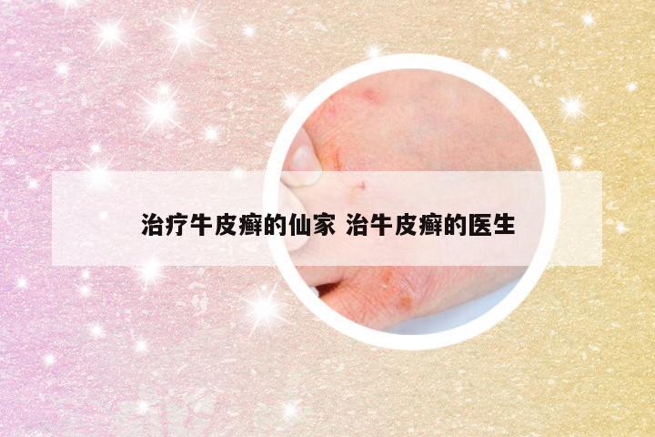 治疗牛皮癣的仙家 治牛皮癣的医生