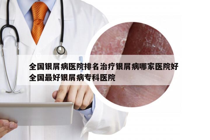 全国银屑病医院排名治疗银屑病哪家医院好 全国最好银屑病专科医院
