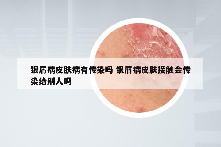 银屑病皮肤病有传染吗 银屑病皮肤接触会传染给别人吗