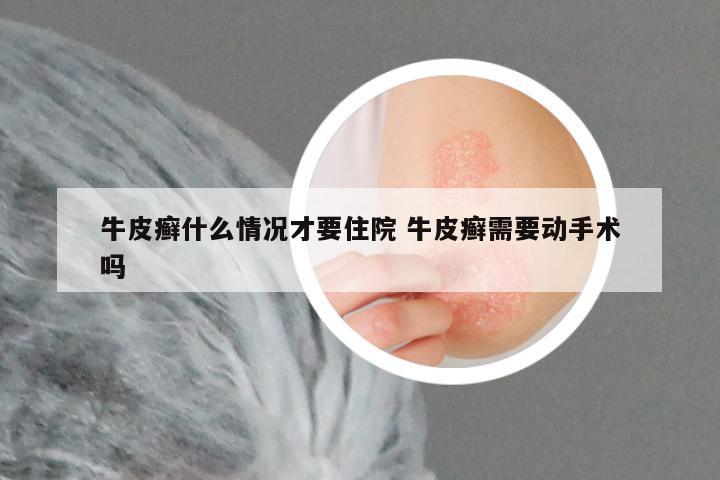 牛皮癣什么情况才要住院 牛皮癣需要动手术吗
