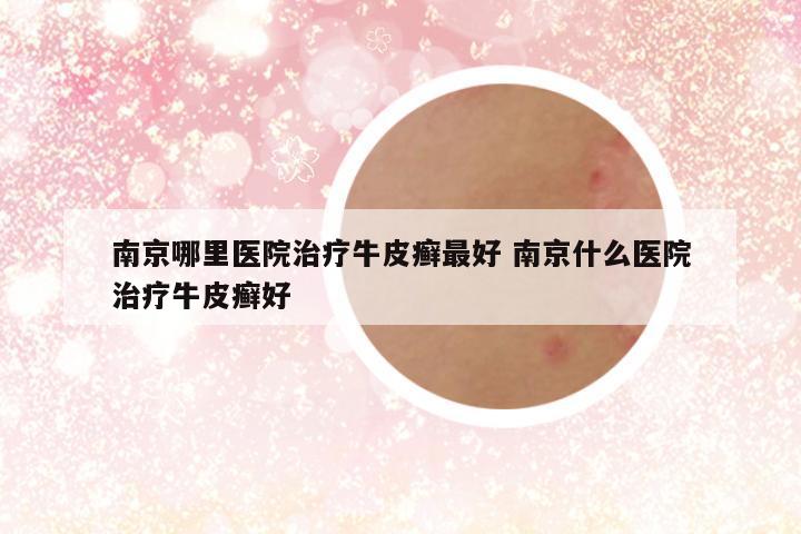 南京哪里医院治疗牛皮癣最好 南京什么医院治疗牛皮癣好