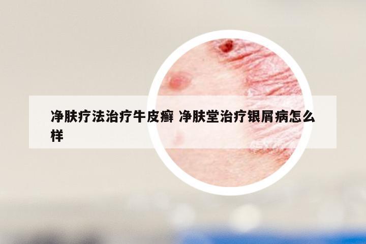 净肤疗法治疗牛皮癣 净肤堂治疗银屑病怎么样