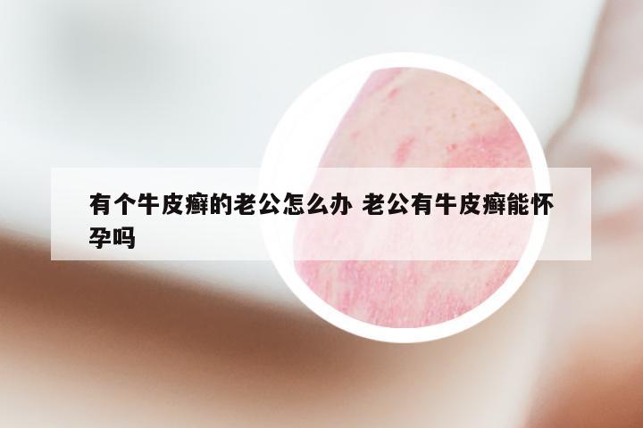 有个牛皮癣的老公怎么办 老公有牛皮癣能怀孕吗