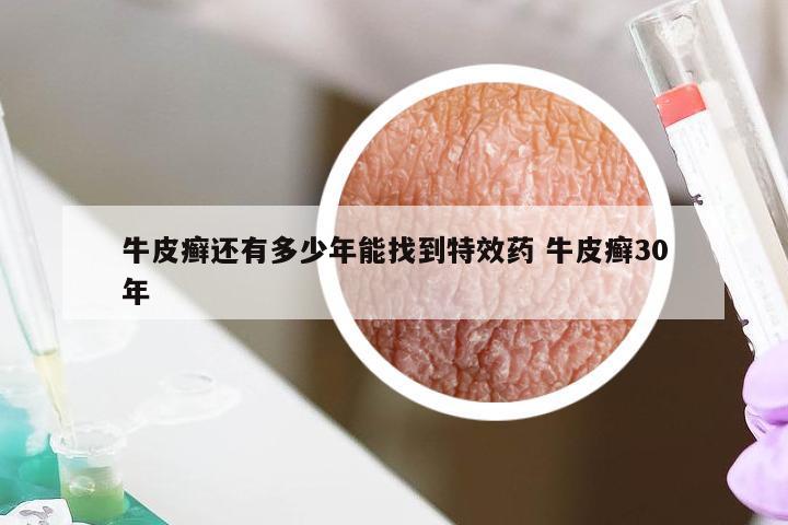 牛皮癣还有多少年能找到特效药 牛皮癣30年