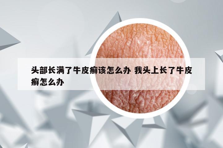 头部长满了牛皮癣该怎么办 我头上长了牛皮癣怎么办