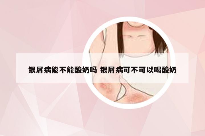 银屑病能不能酸奶吗 银屑病可不可以喝酸奶