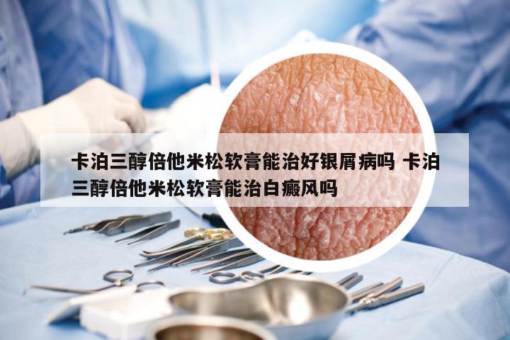 卡泊三醇倍他米松软膏能治好银屑病吗 卡泊三醇倍他米松软膏能治白癜风吗