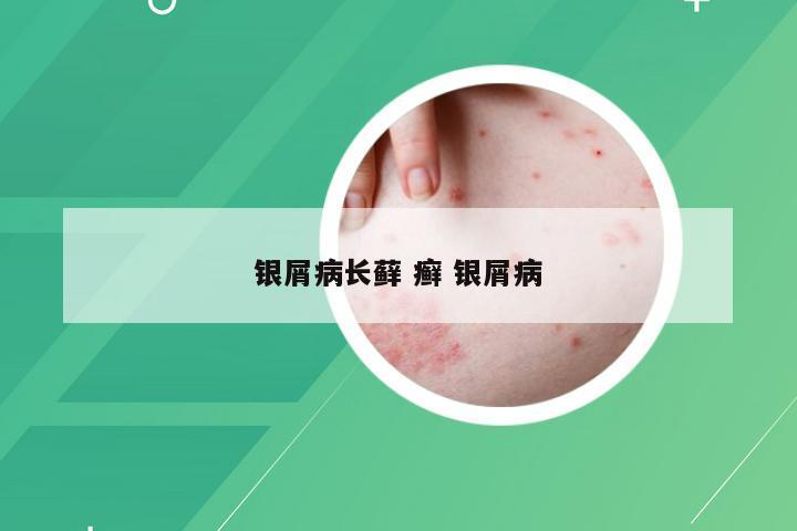 银屑病长藓 癣 银屑病