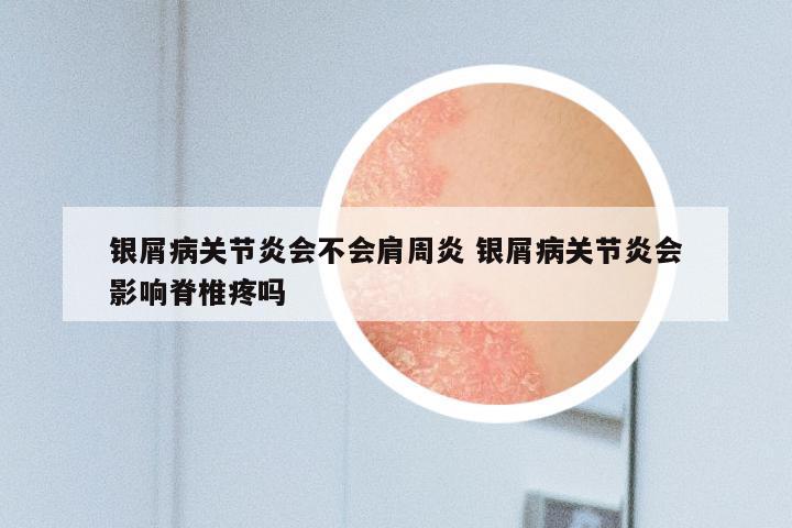 银屑病关节炎会不会肩周炎 银屑病关节炎会影响脊椎疼吗