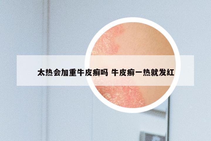 太热会加重牛皮癣吗 牛皮癣一热就发红