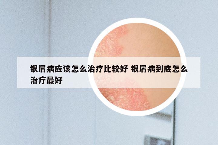 银屑病应该怎么治疗比较好 银屑病到底怎么治疗最好