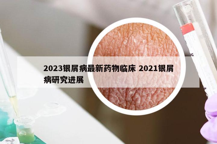 2023银屑病最新药物临床 2021银屑病研究进展