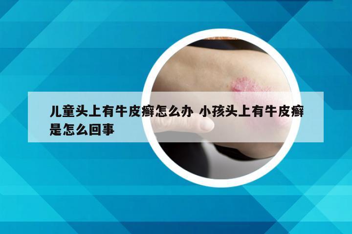 儿童头上有牛皮癣怎么办 小孩头上有牛皮癣是怎么回事