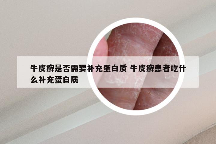 牛皮癣是否需要补充蛋白质 牛皮癣患者吃什么补充蛋白质