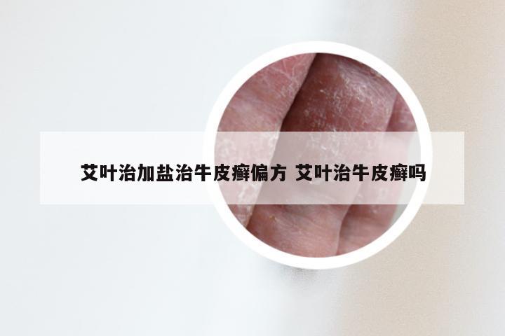 艾叶治加盐治牛皮癣偏方 艾叶治牛皮癣吗