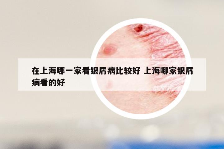 在上海哪一家看银屑病比较好 上海哪家银屑病看的好