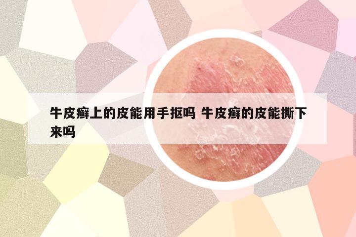 牛皮癣上的皮能用手抠吗 牛皮癣的皮能撕下来吗