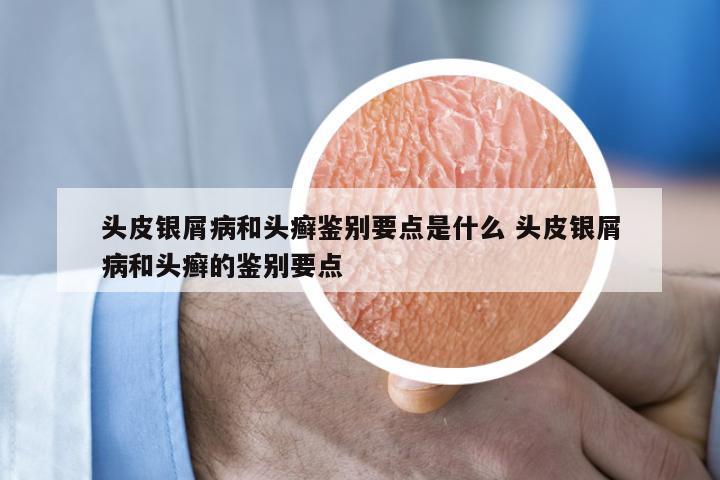 头皮银屑病和头癣鉴别要点是什么 头皮银屑病和头癣的鉴别要点