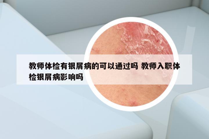 教师体检有银屑病的可以通过吗 教师入职体检银屑病影响吗