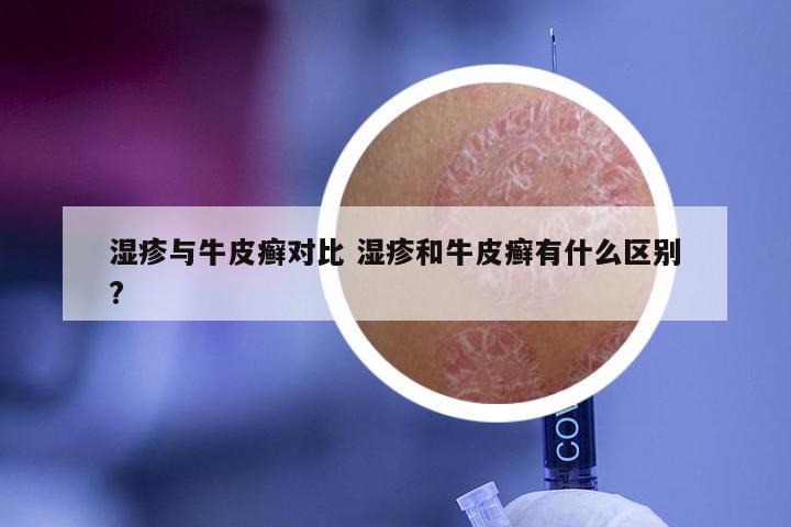 湿疹与牛皮癣对比 湿疹和牛皮癣有什么区别?