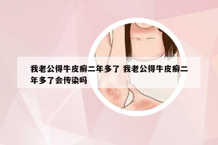 我老公得牛皮癣二年多了 我老公得牛皮癣二年多了会传染吗