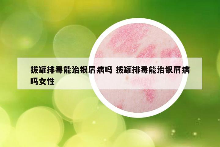 拔罐排毒能治银屑病吗 拔罐排毒能治银屑病吗女性