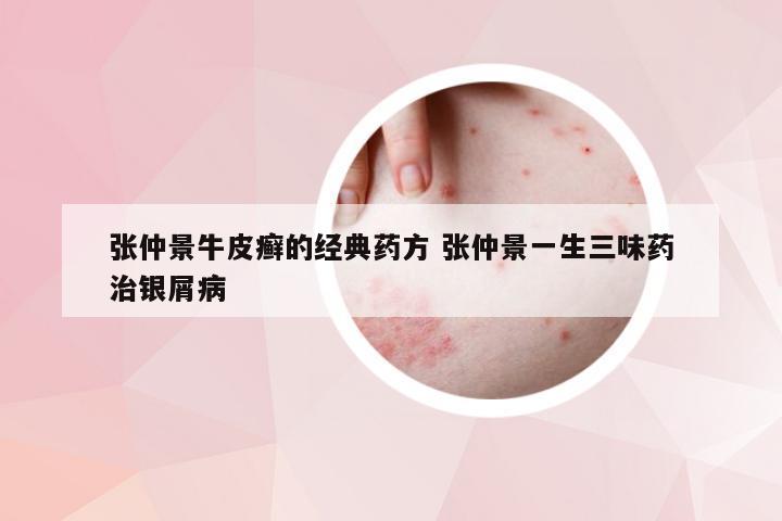 张仲景牛皮癣的经典药方 张仲景一生三味药治银屑病