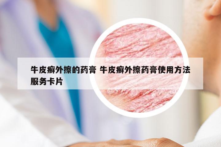 牛皮癣外擦的药膏 牛皮癣外擦药膏使用方法服务卡片