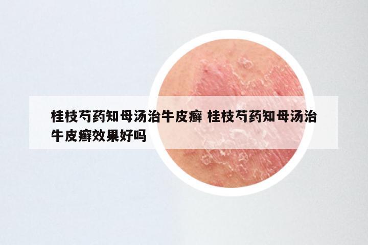 桂枝芍药知母汤治牛皮癣 桂枝芍药知母汤治牛皮癣效果好吗