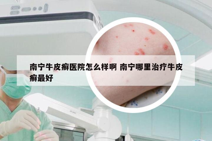 南宁牛皮癣医院怎么样啊 南宁哪里治疗牛皮癣最好