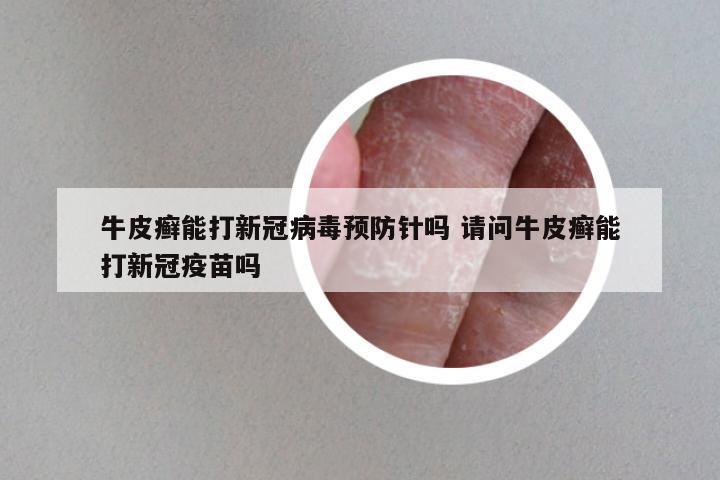 牛皮癣能打新冠病毒预防针吗 请问牛皮癣能打新冠疫苗吗