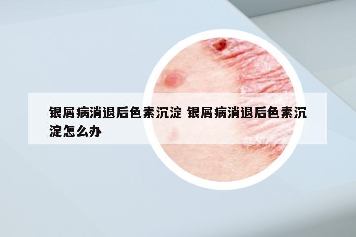 银屑病消退后色素沉淀 银屑病消退后色素沉淀怎么办