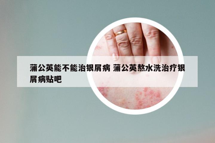 蒲公英能不能治银屑病 蒲公英熬水洗治疗银屑病贴吧