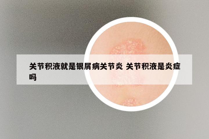 关节积液就是银屑病关节炎 关节积液是炎症吗