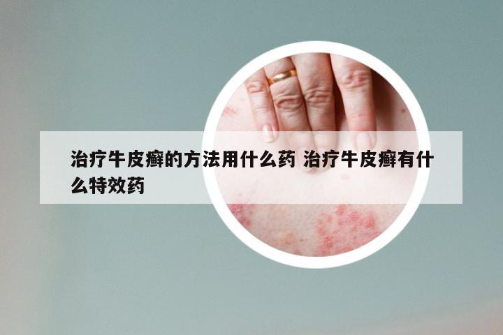 治疗牛皮癣的方法用什么药 治疗牛皮癣有什么特效药