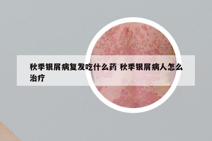 秋季银屑病复发吃什么药 秋季银屑病人怎么治疗