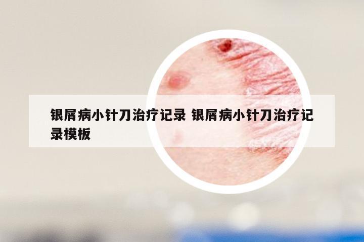 银屑病小针刀治疗记录 银屑病小针刀治疗记录模板